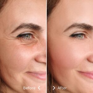 anti wrinkle injection 1
