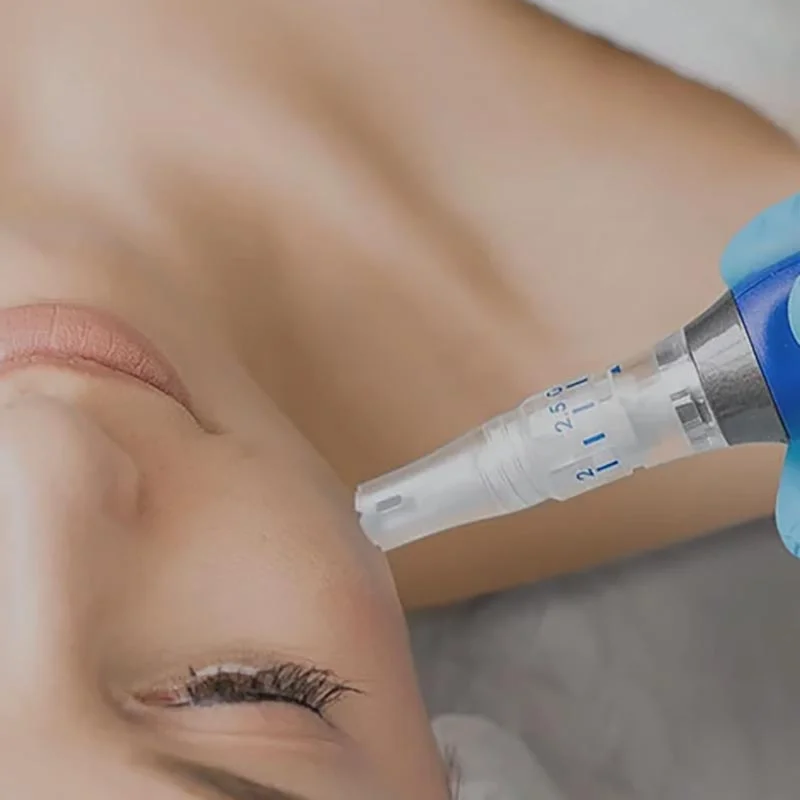 Skin Needling Treatment Newcastle