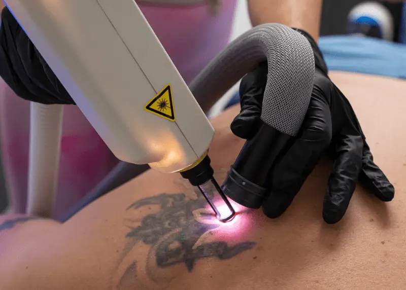 Laser Tattoo Removal Newcastle - Skinduced Aesthetics Clinic