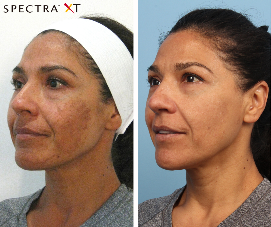 spectra pigmentation results