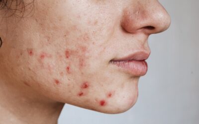 Help Me Skinduced I have hormonal acne
