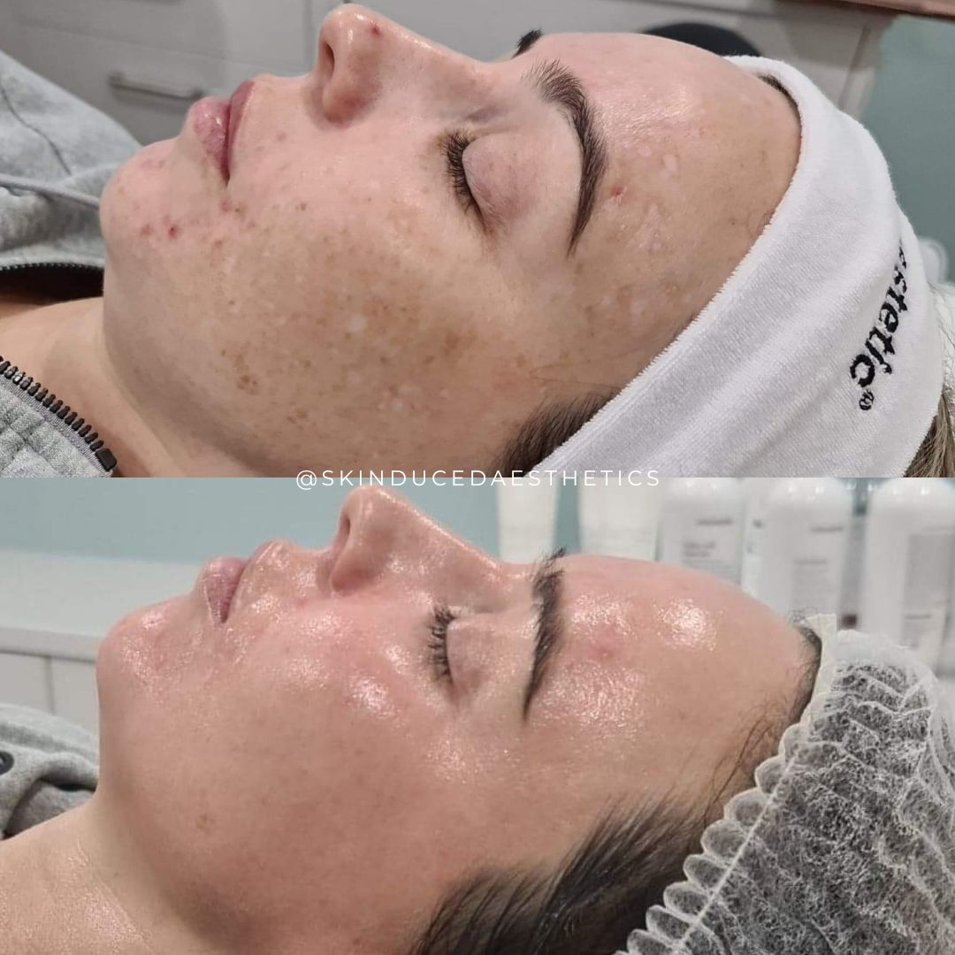 Forma Skin Tightening