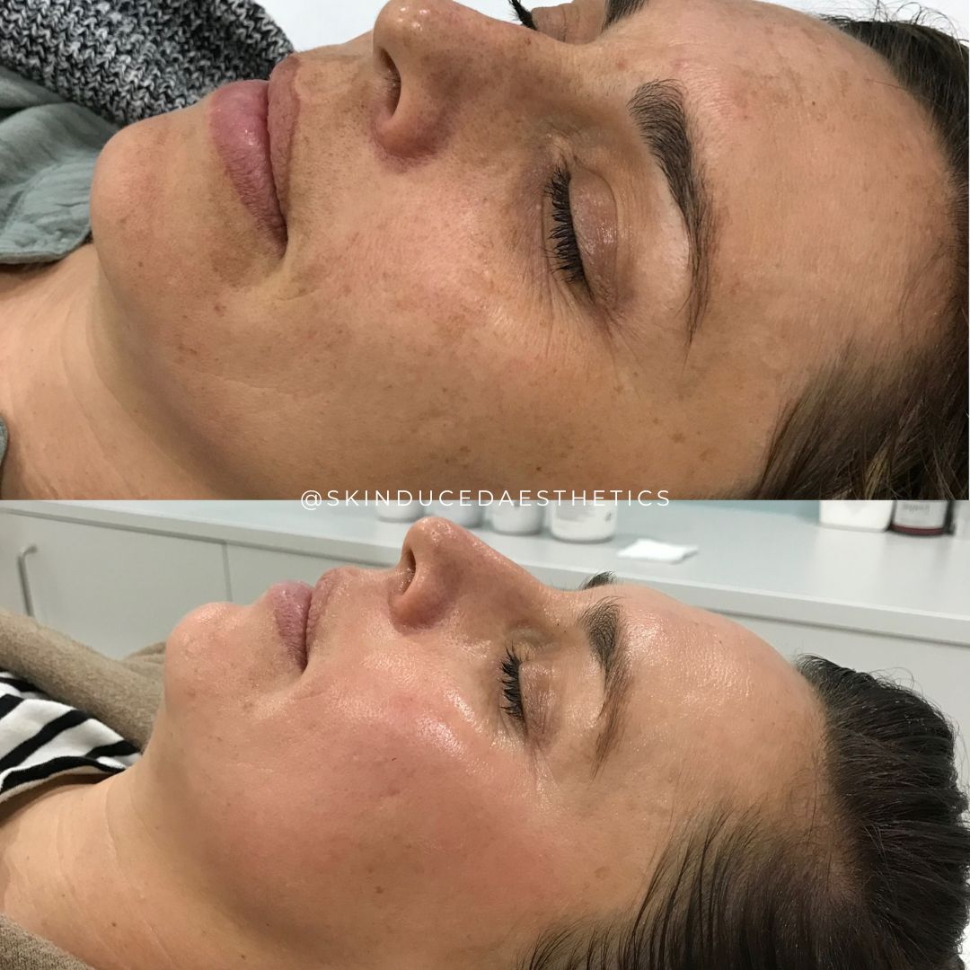 Forma Skin Tightening