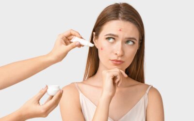 Busting Acne Myths