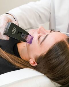 Skinduced's qualified nurse applying morpheus 8 device to the skin of a young lady