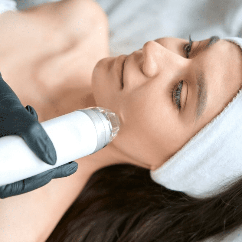 Lasser hair removeal