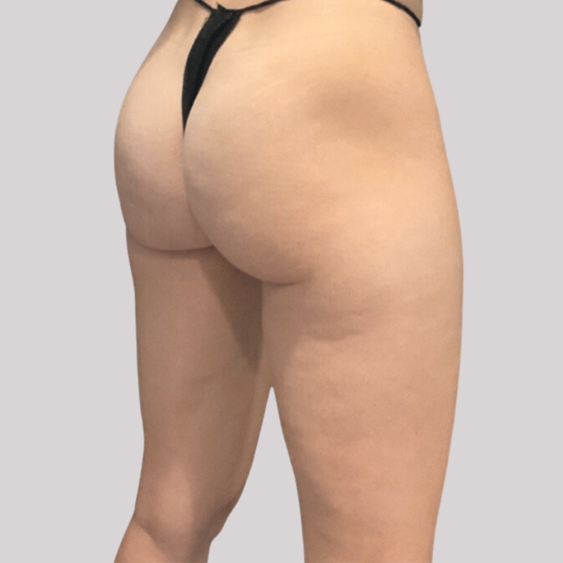 emsculpt buttocks after 1