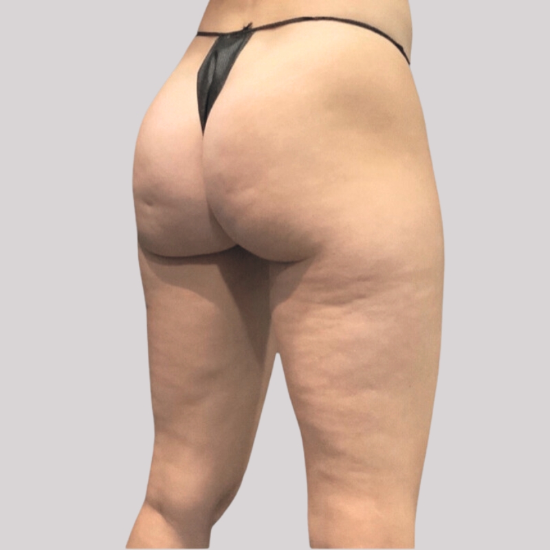 emsculpt buttocks before 2