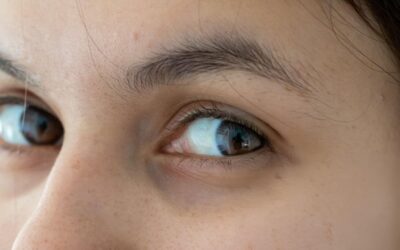 Say Goodbye to Dark Circles Under Eyes with Targeted Laser Treatment