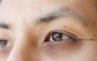 Say Goodbye to Dark Circles Under Eyes with Targeted Laser Treatment