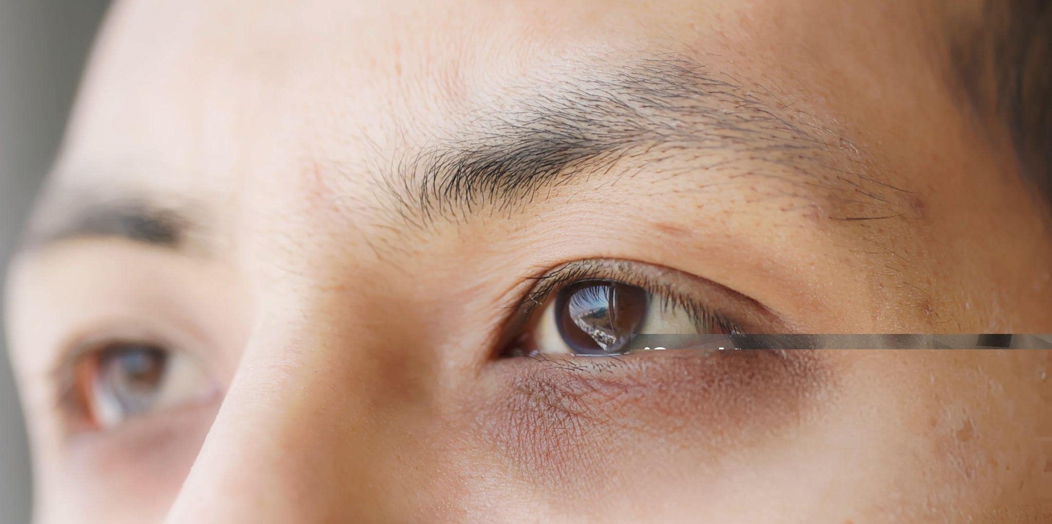 dark circle under eyes