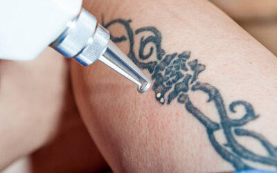 Laser Tattoo Removal Aftercare:A Detail guide