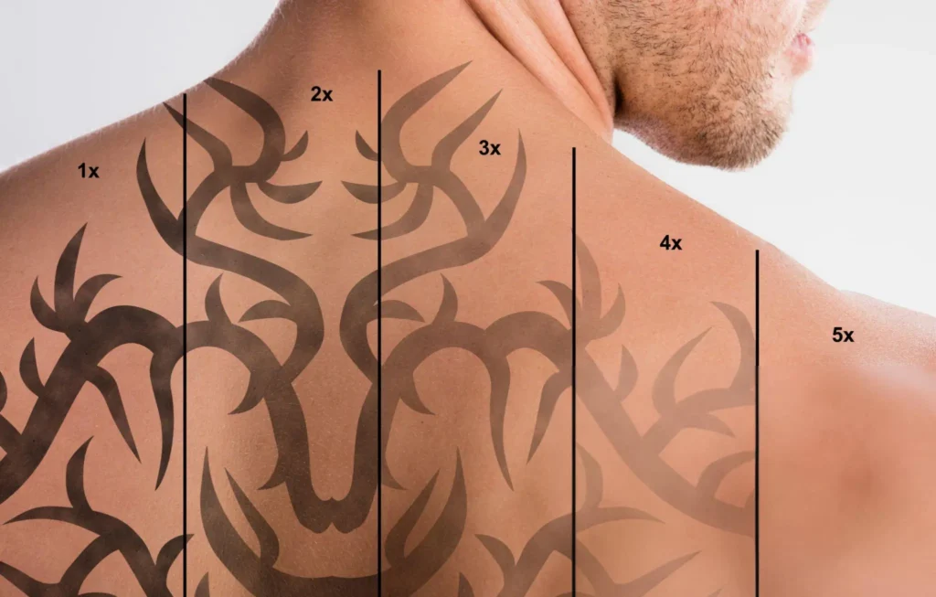 laser tattoo removal aftercare