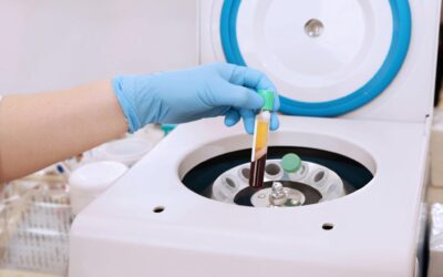 PRP for Hair Loss – How It Helps Regrow Your Hair