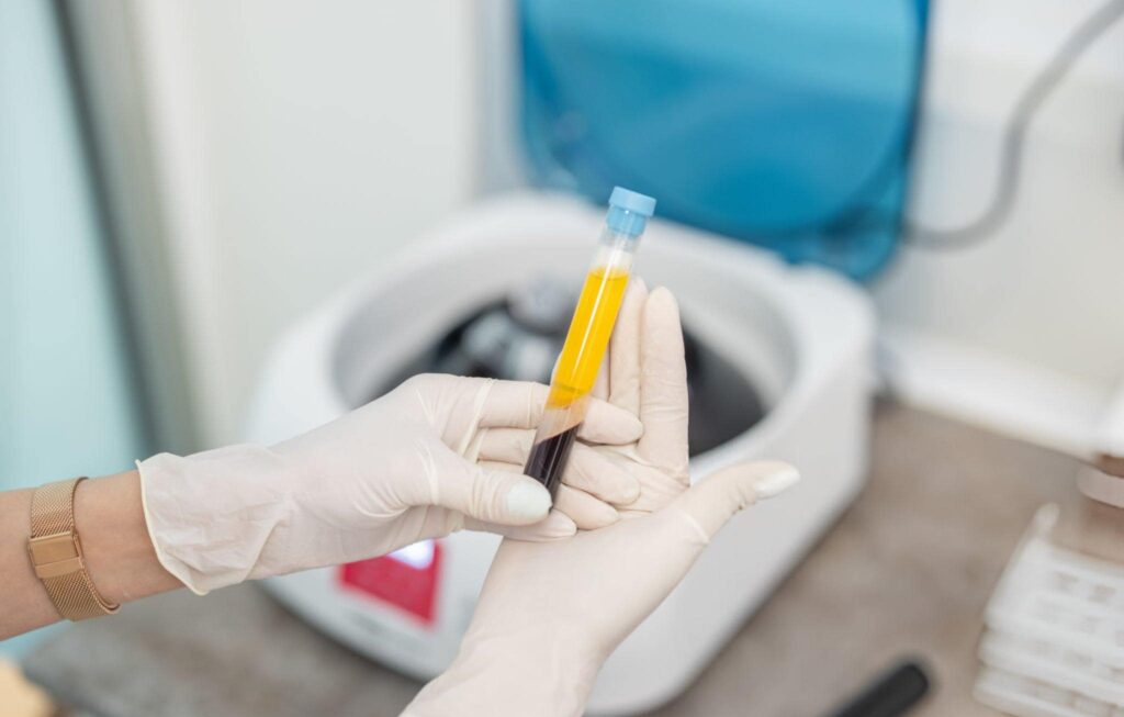 prp treatment for hair loss