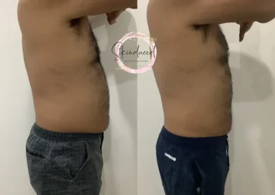 fat freezing belly fat before and after