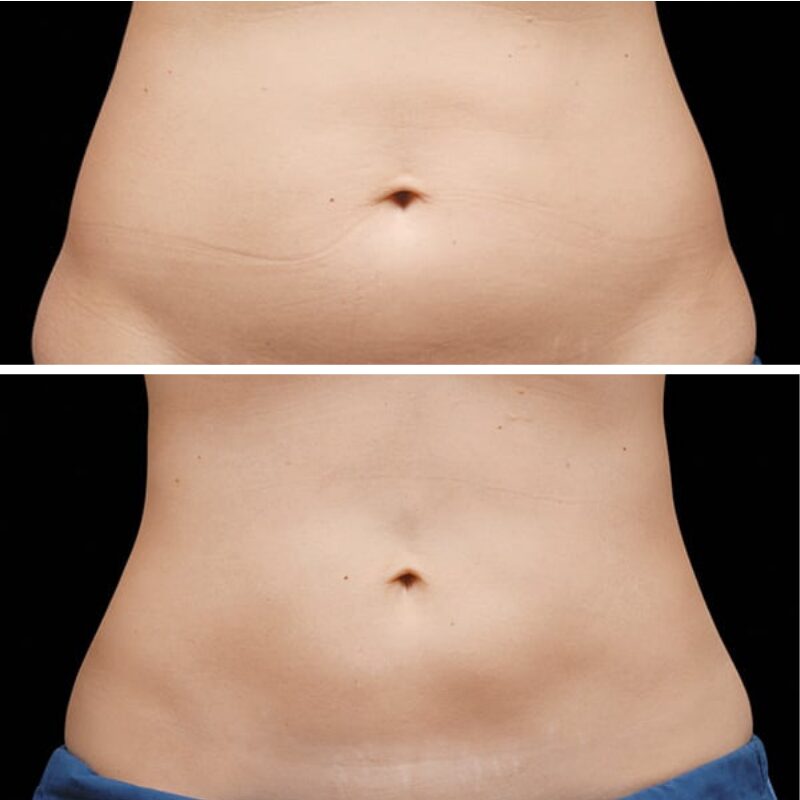 female abdomen fat before and after