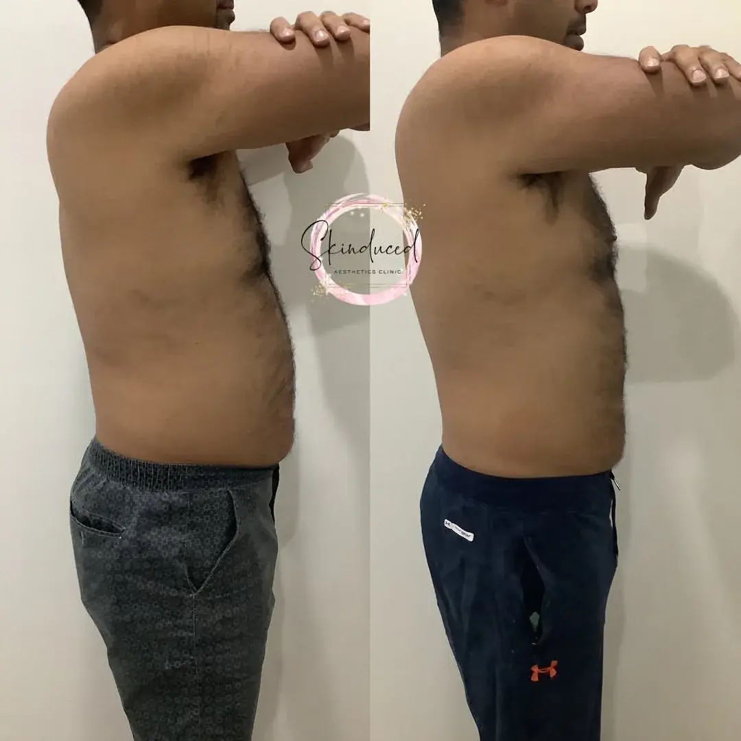 fat freezing belly fat before and after