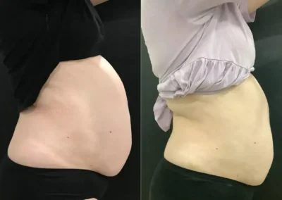 female stubborn fat pocket before and after