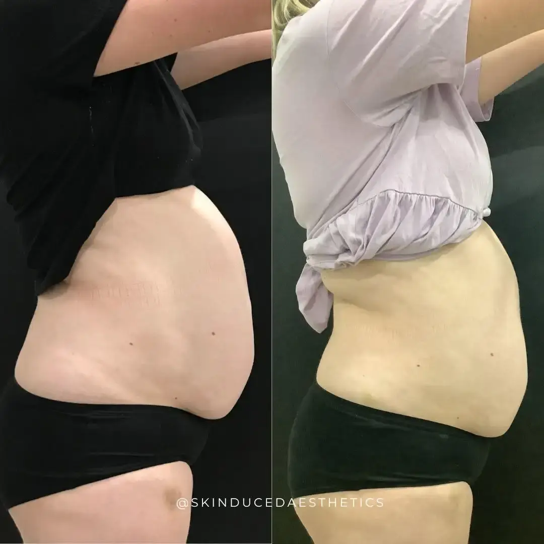 female stubborn fat pocket before and after