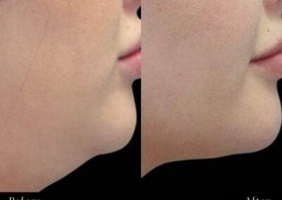 double chin fat-freezing before and after