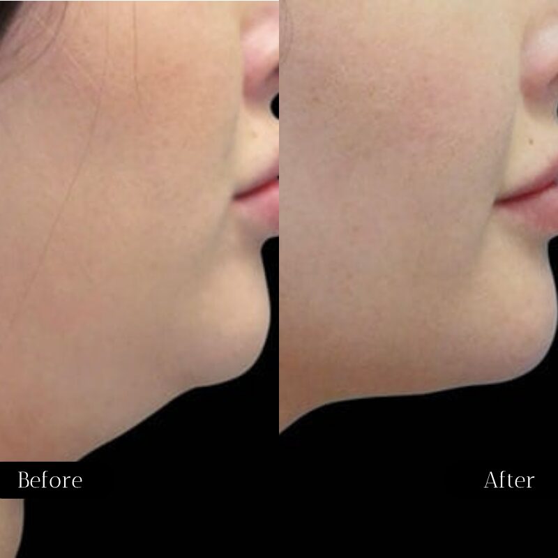double chin fat-freezing before and after