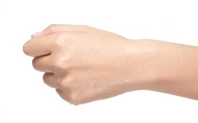 How to Stop Hyperhidrosis on Hands – Causes, Tips & Treatments