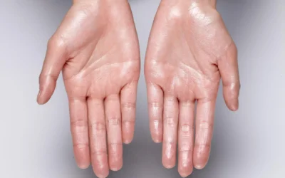 How to Stop Sweaty Hands in Australia: What Works & What Doesn’t