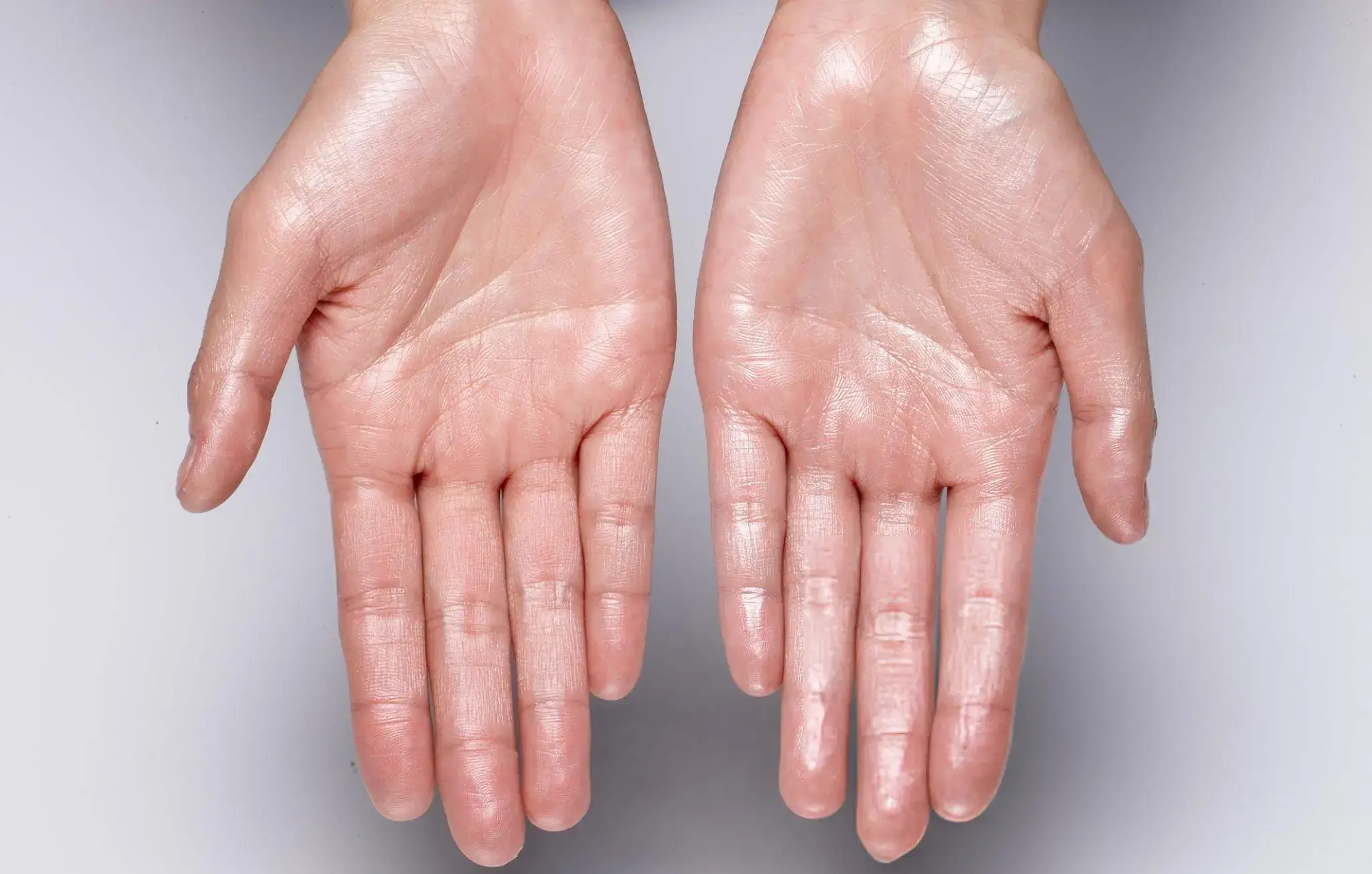 How to Stop Sweaty Hands
