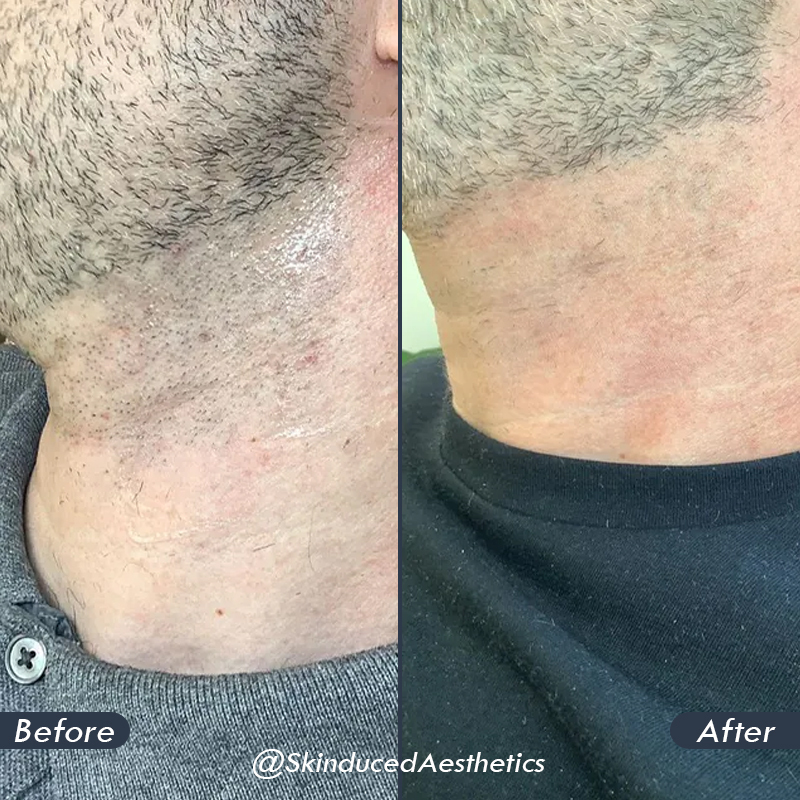 beard sculpting before and after