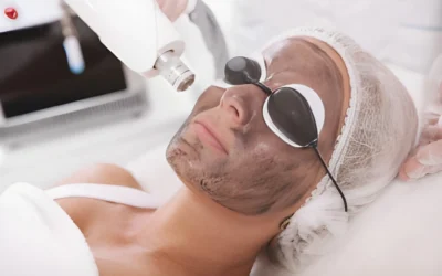 What Is a Carbon Laser Peel and How Does It Work?