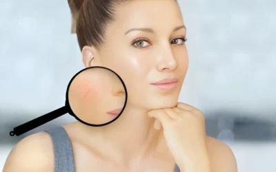 Vascular Laser Treatment in Newcastle, NSW: Safe Solution for Veins & Rosacea