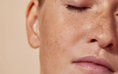 How Do You Remove Freckles? Safe and Effective Treatment Options