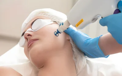 Laser Treatment for Pigmentation in Australia: Cost, Results and Treatment Options