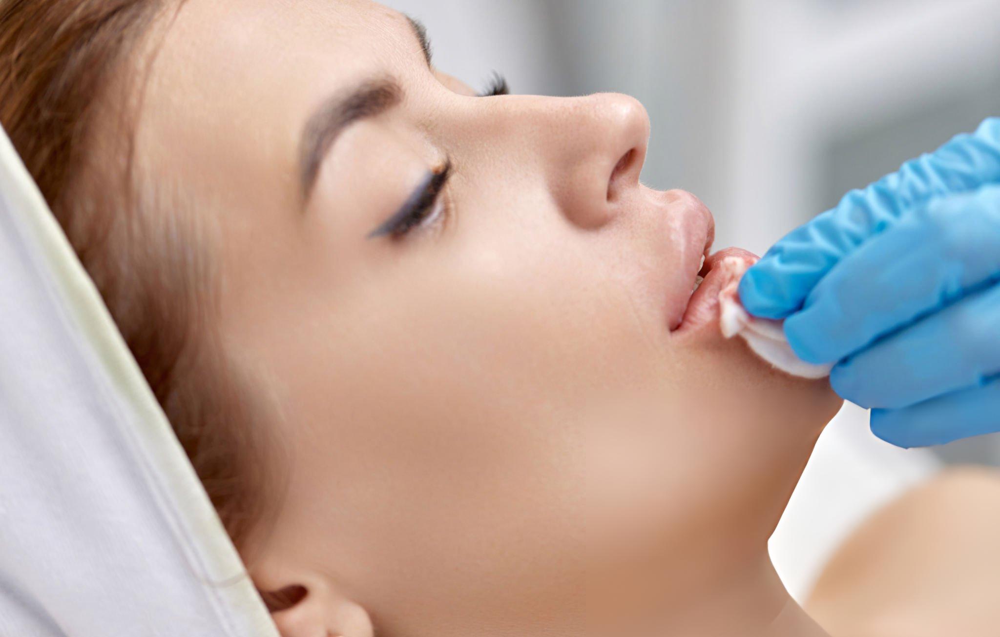 Natural Lip Augmentation