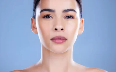 What Is Uneven Skin Tone: Causes and Effective Pigmentation Removal Treatments