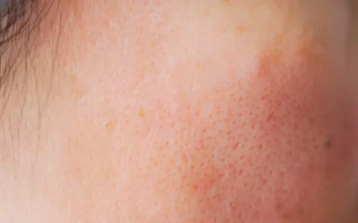 Enlarged Pores Treatment: How RF Microneedling Shrinks Pores Safely