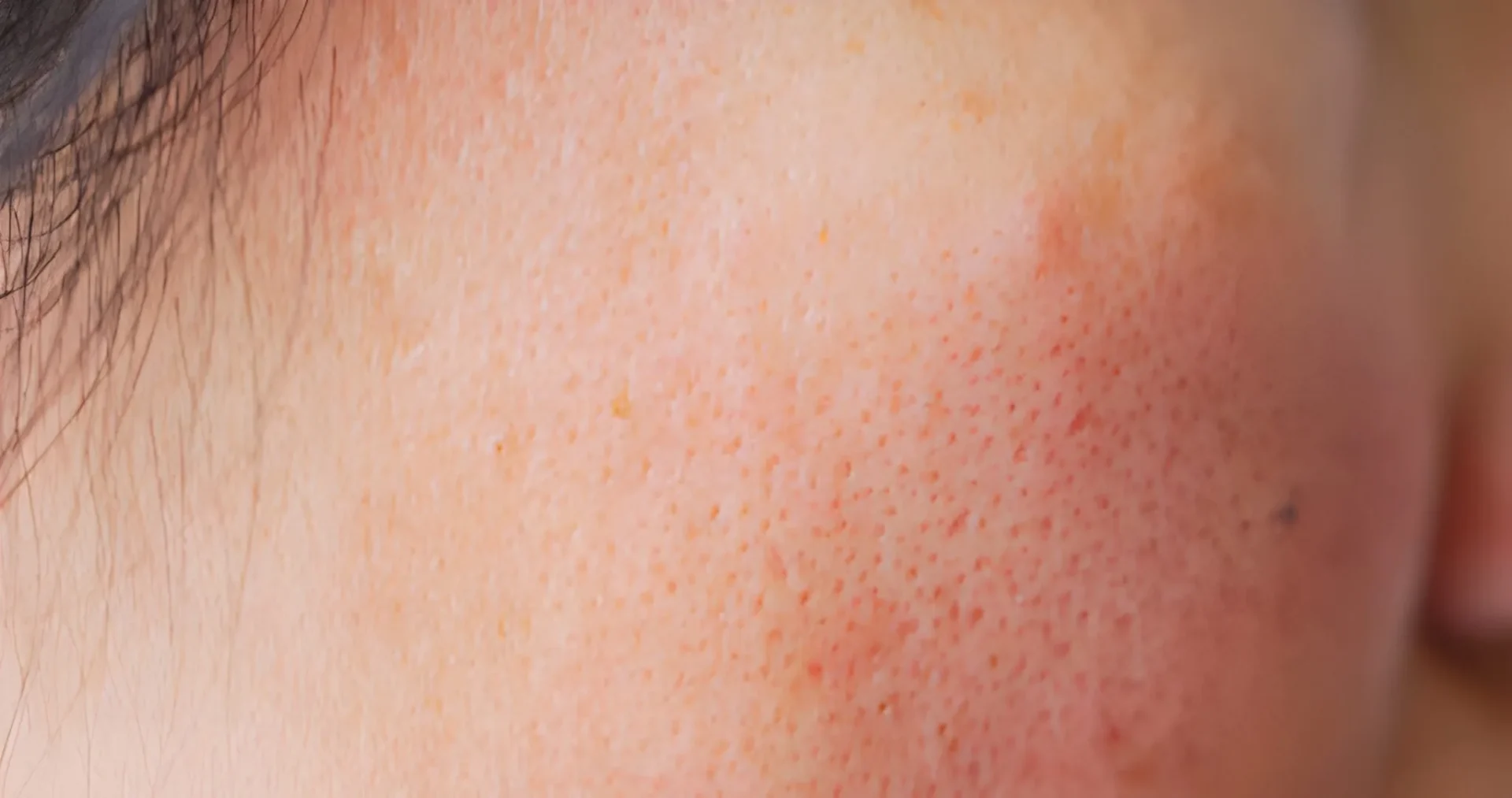 Enlarged Pores Treatment Enlarged Pores Treatment