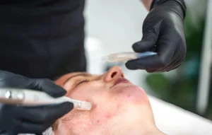 Skin Needling vs Chemical Peels Skin Needling vs Chemical Peels