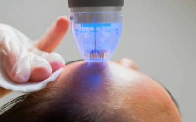 What Is RF Microneedling? Benefits, Results & How It Works