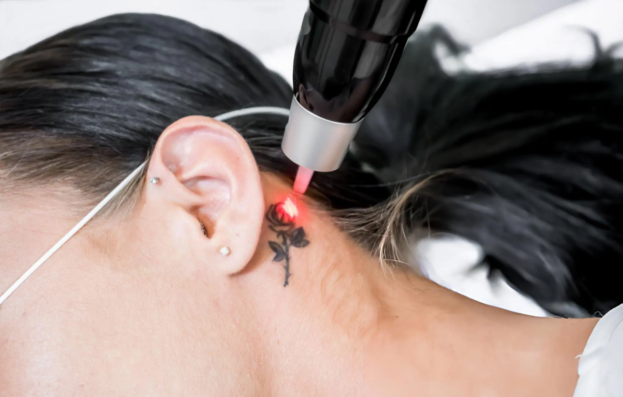 How Much Does It Cost for Laser Tattoo Removal How Much Does It Cost for Laser Tattoo Removal