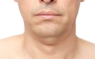 How to Remove Neck Fat – Treatment Options, Cost, and Next Steps