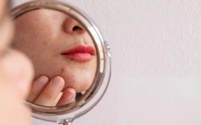 How to Fix Damaged Skin Barrier