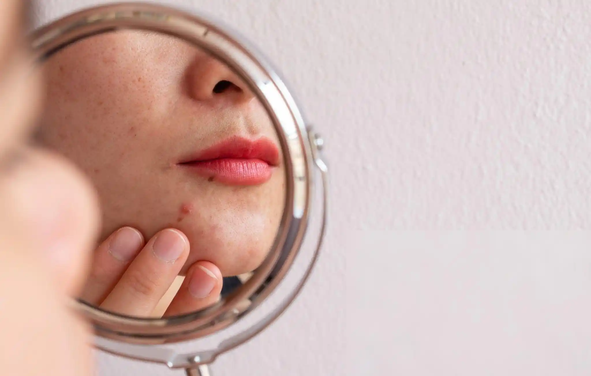Damaged Skin Barrier Damaged Skin Barrier