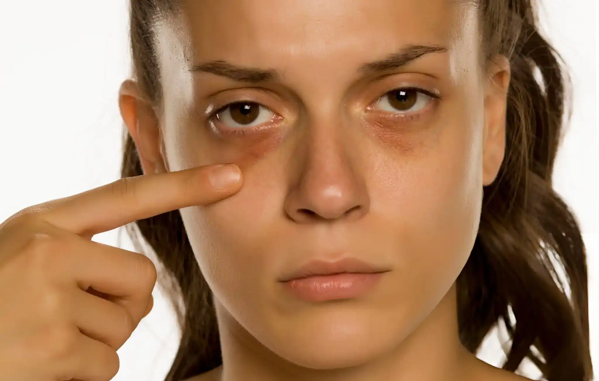 How to Get Rid of Dark Circles