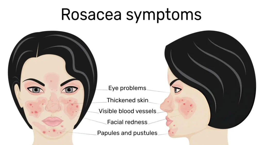 Common Signs and Symptoms of Rosacea