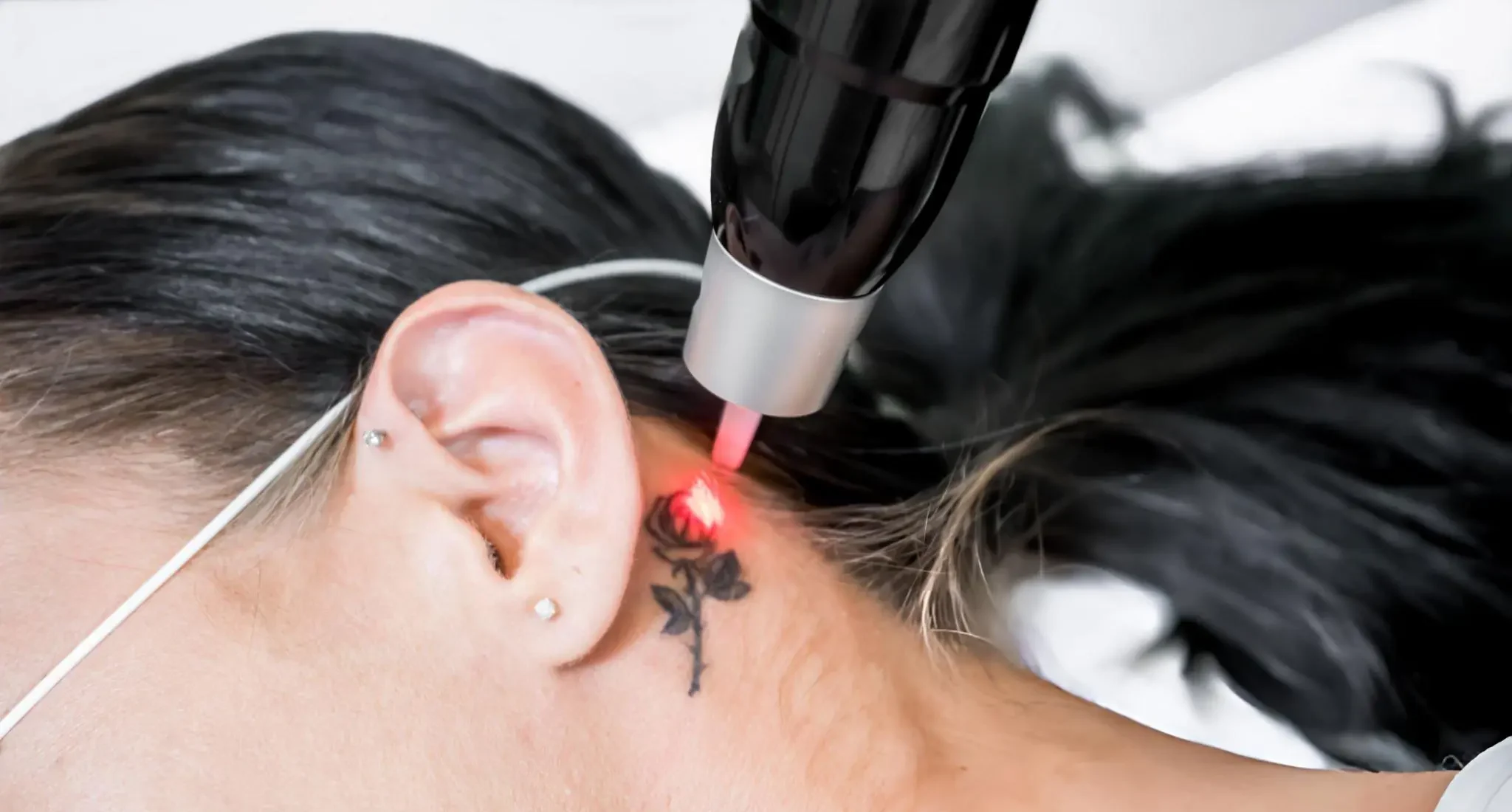 Laser Tattoo Removal