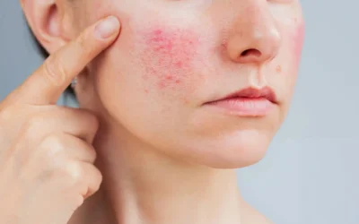Can You Get Rid of Rosacea? Signs, Symptoms and Treatment Options