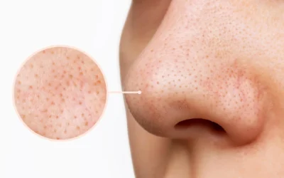 Blackheads vs Sebaceous Filaments – What Is the Difference?