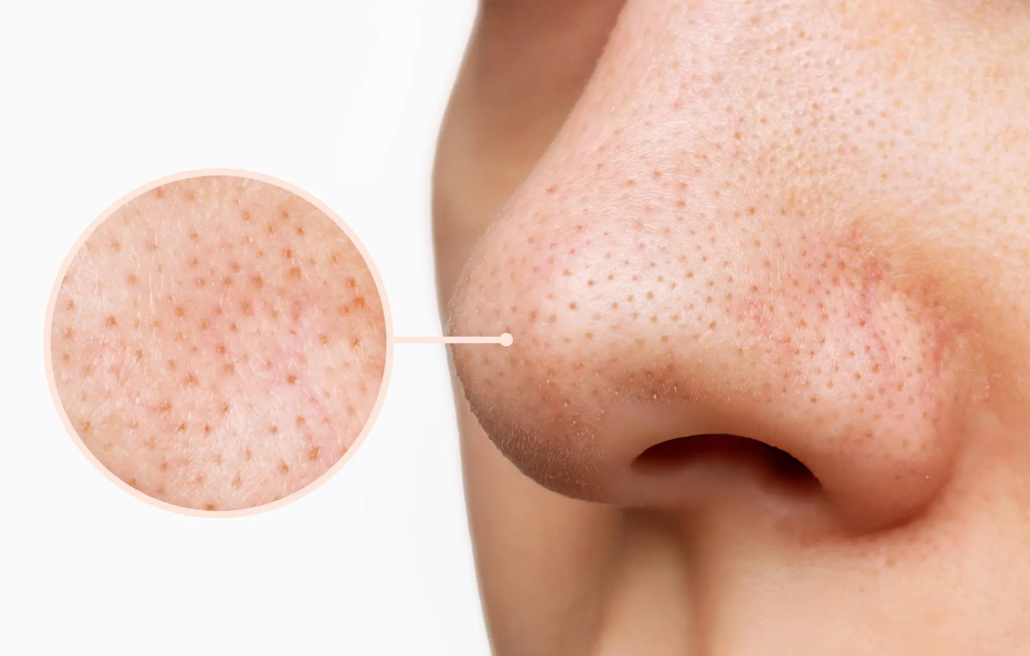 Blackheads vs Sebaceous Filaments